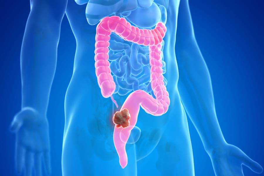 Día Mundial de la Prevención del Cáncer Colorrectal