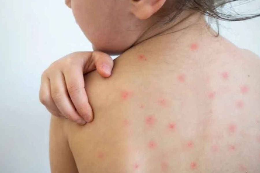 Sarampión: alarma en Ciudad y provincia de Buenos Aires por aumento de casos