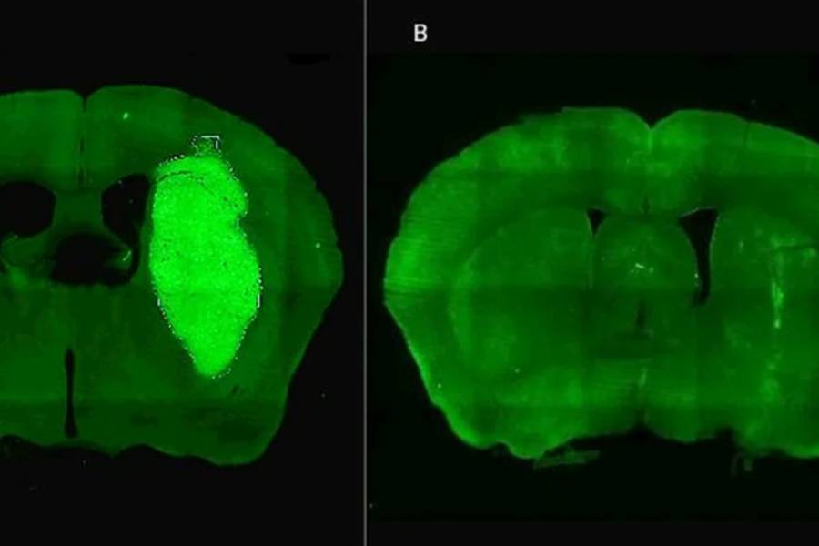 Especialistas del CONICET lograron frenar un tipo de cáncer cerebral con una novedosa estrategia terapéutica