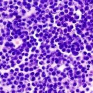 Cuál es la nueva opción de tratamiento para pacientes con mieloma múltiple aprobada por la ANMAT