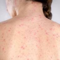 Alerta epidemiológica por nuevos casos de sarampión