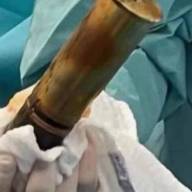 Evacúan hospital en Toulouse por proyectil de la Primera Guerra Mundial alojado en un paciente