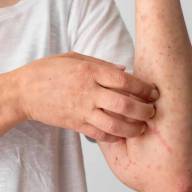 Alerta por un nuevo caso importado de sarampión en el país