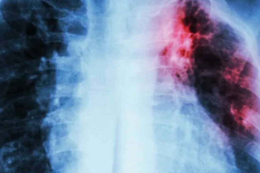 El histórico avance de científicos de la UBA que busca cambiar para siempre el tratamiento de la tuberculosis